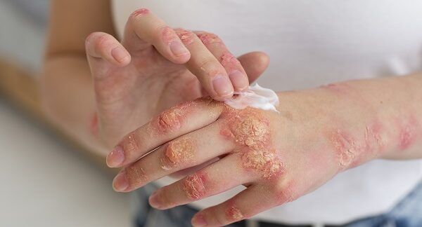 I 10 migliori centri per la psoriasi a Roma